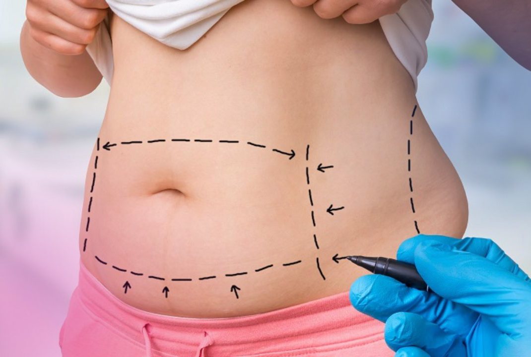 Liposuction